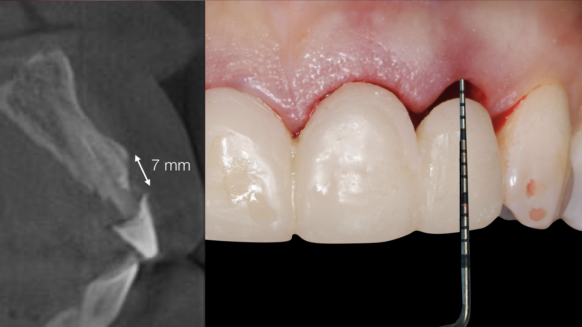 Vulkan Implants Clinical Case