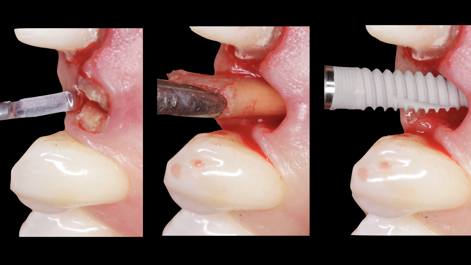 Vulkan Implants Clinical Case