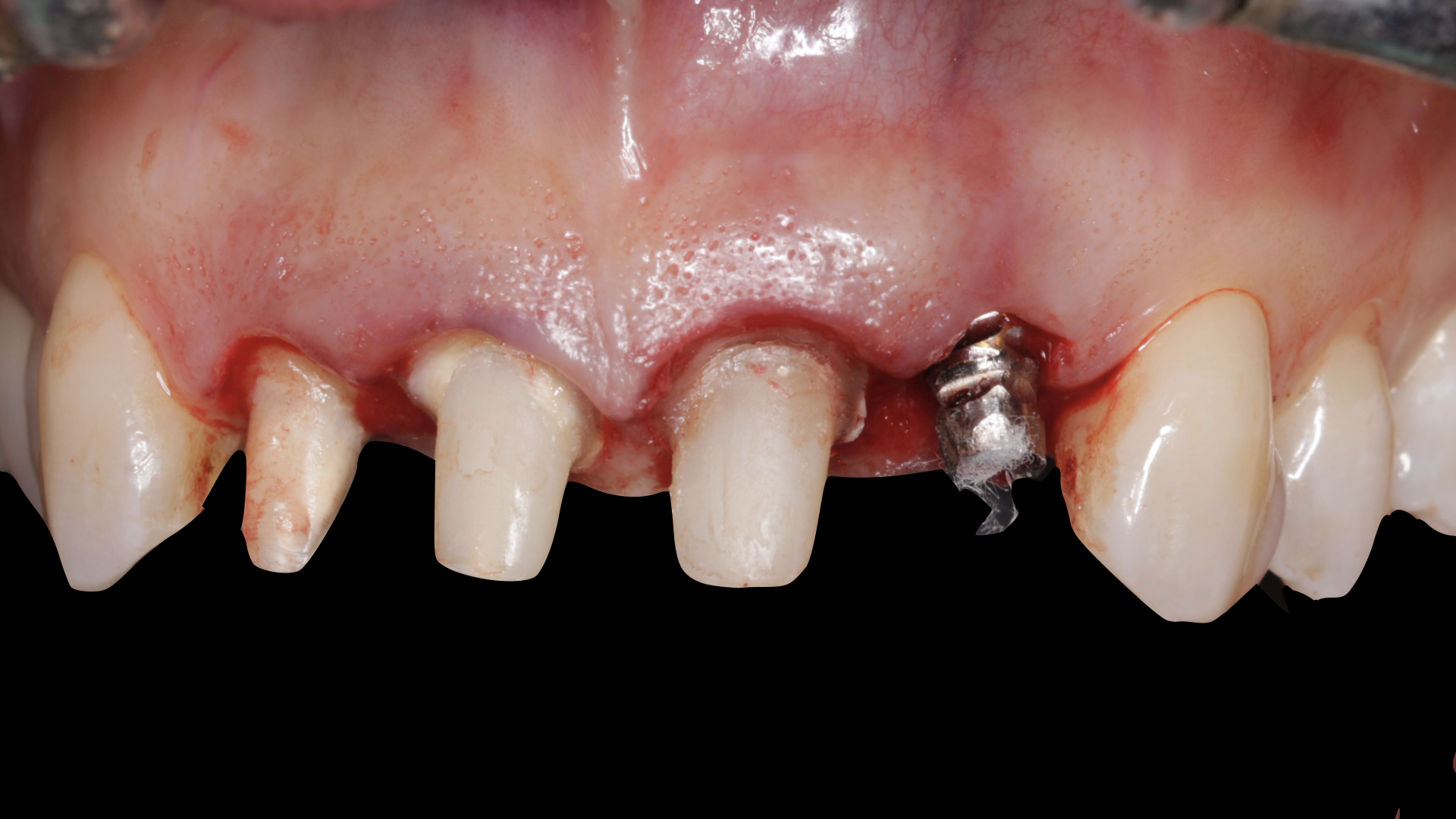 Vulkan Implants Clinical Case