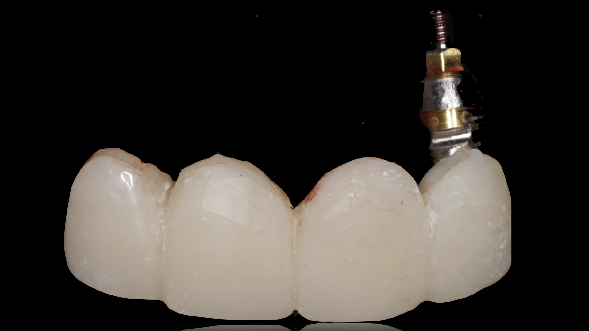 Vulkan Implants Clinical Case