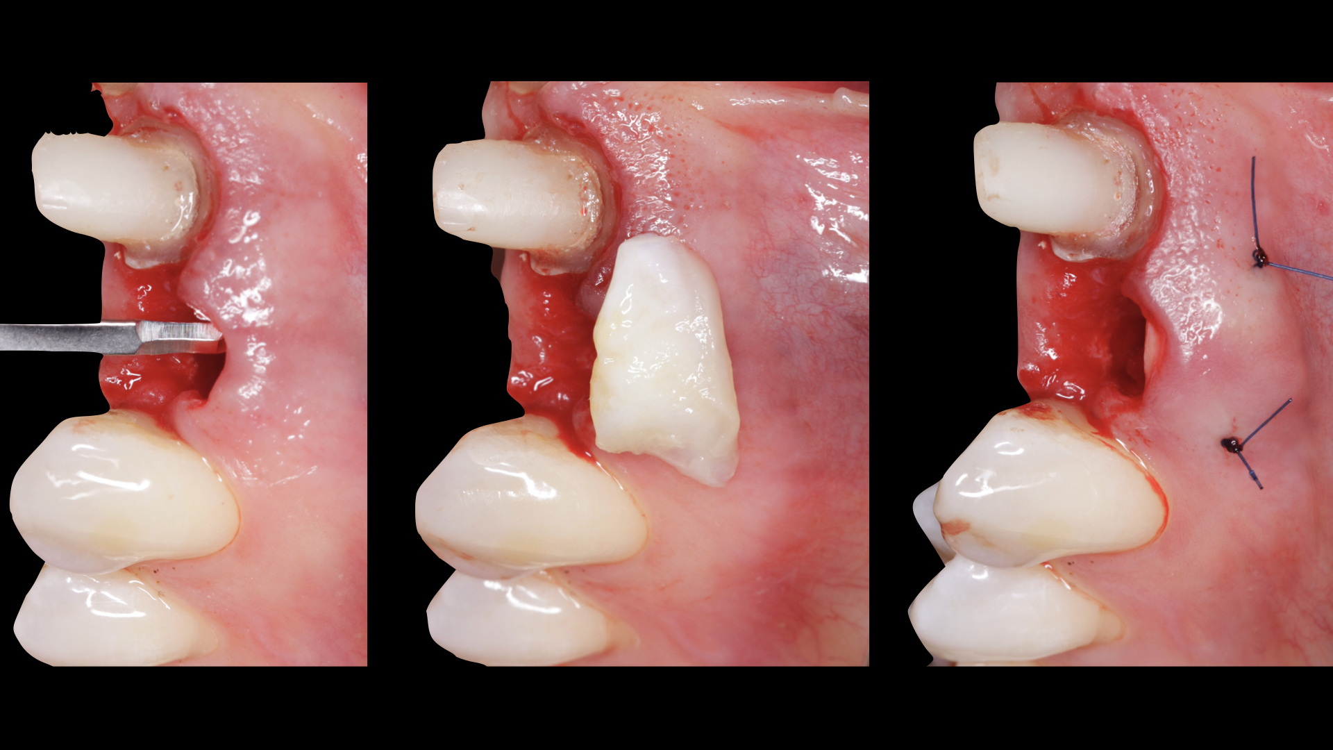 Vulkan Implants Clinical Case