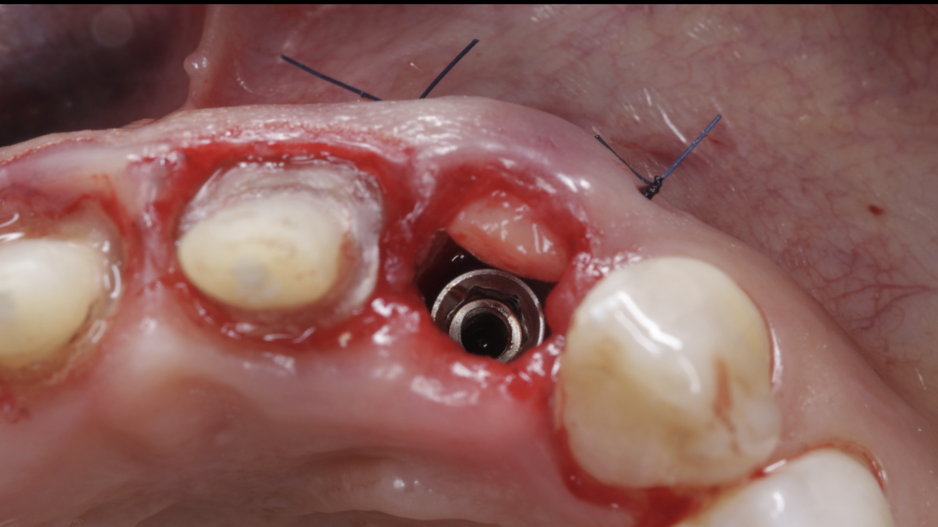 Vulkan Implants Clinical Case