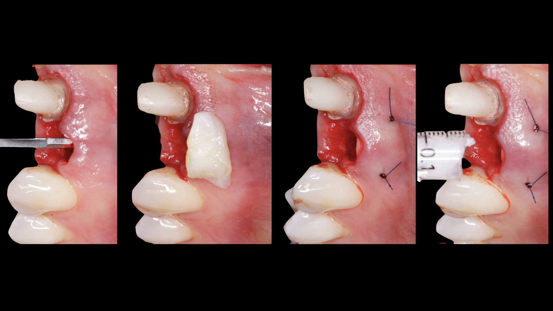 Vulkan Implants Clinical Case