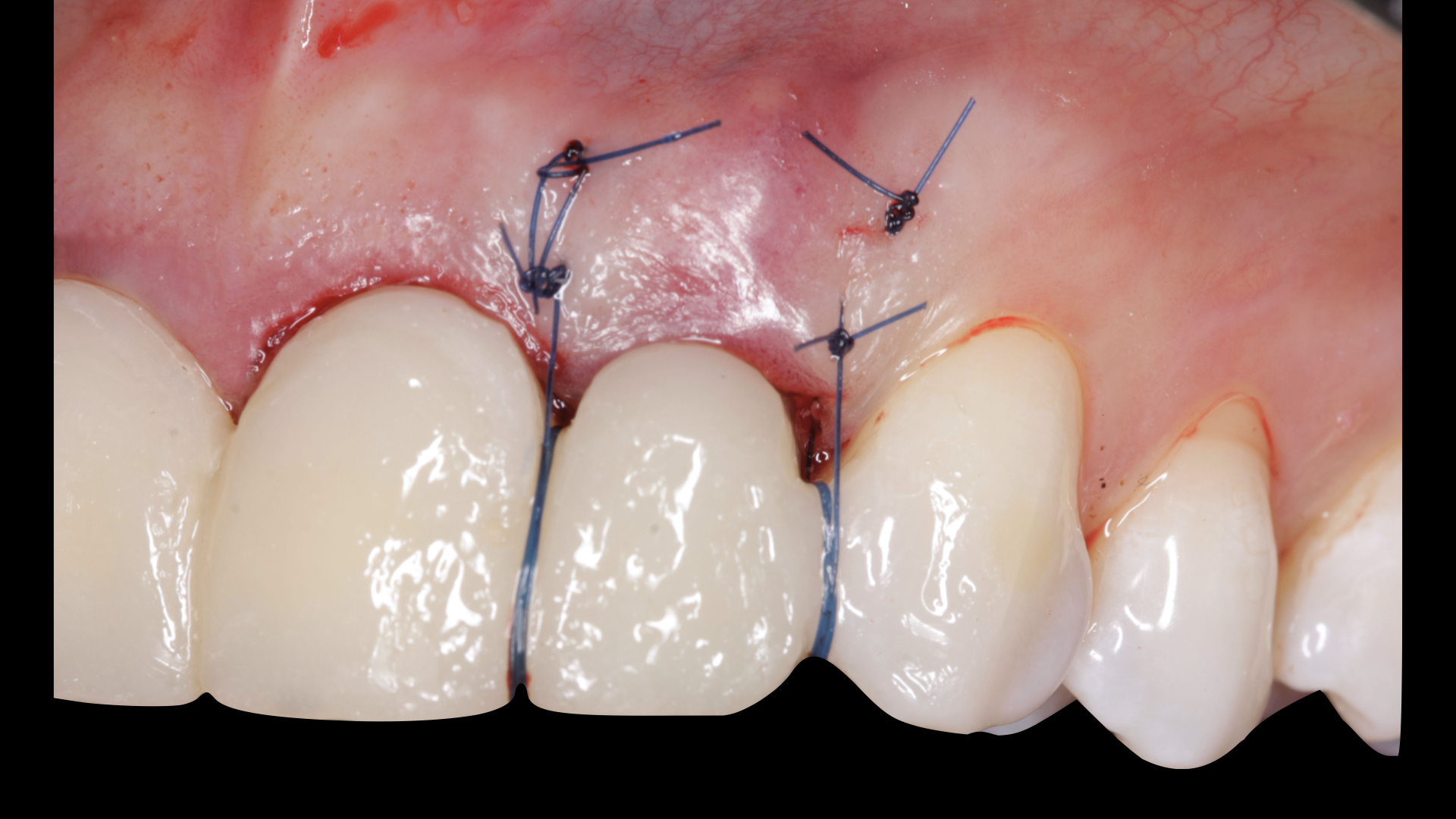 Vulkan Implants Clinical Case