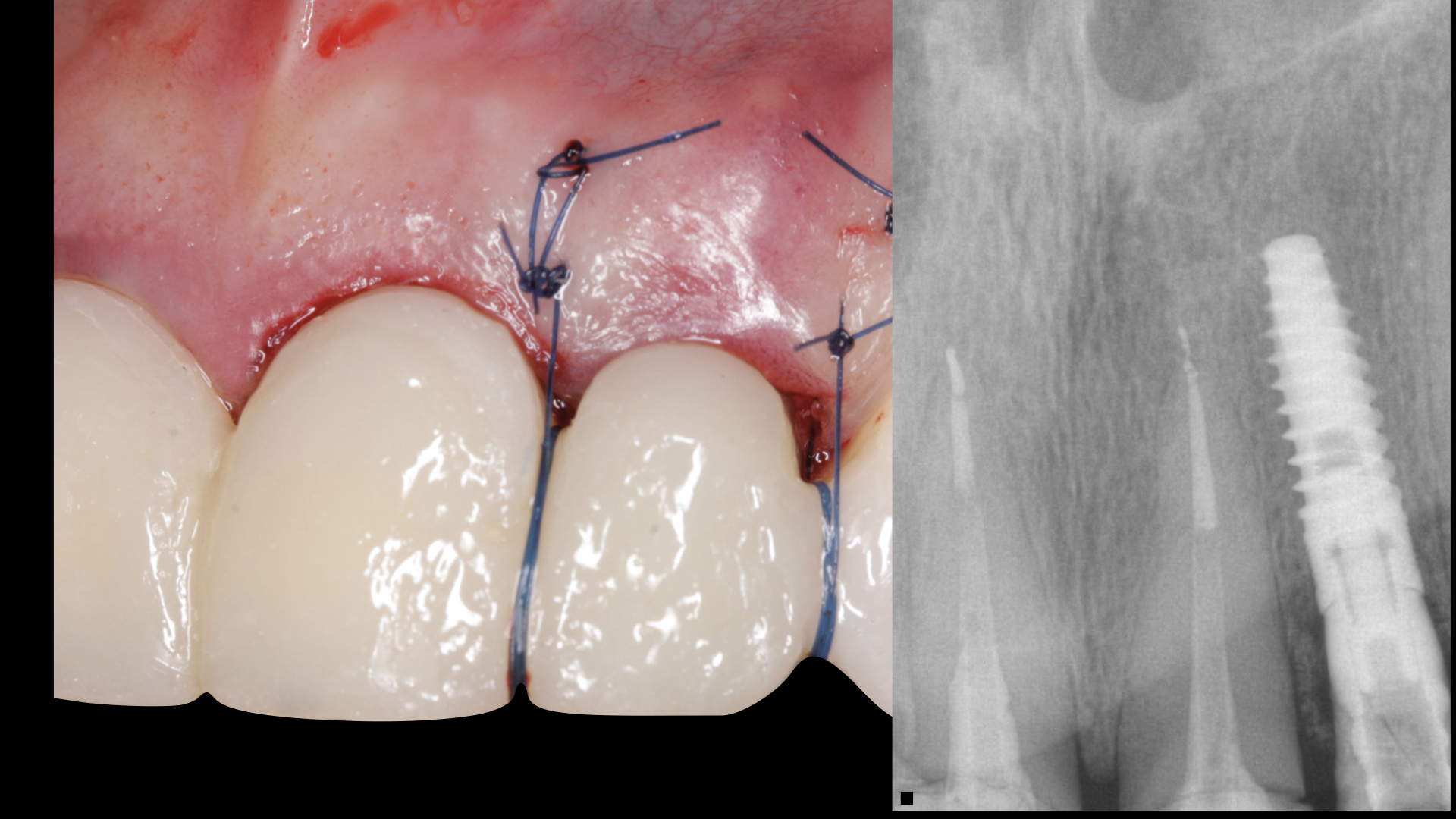 Vulkan Implants Clinical Case