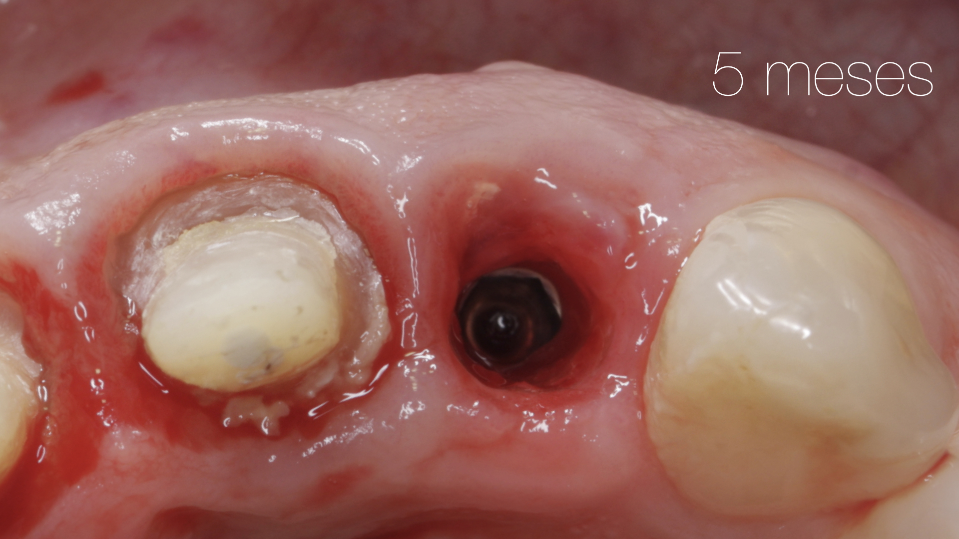 Vulkan Implants Clinical Case