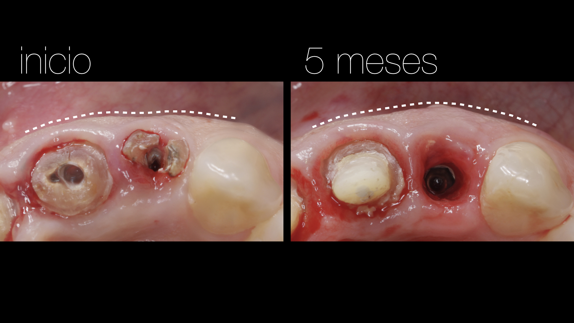 Vulkan Implants Clinical Case