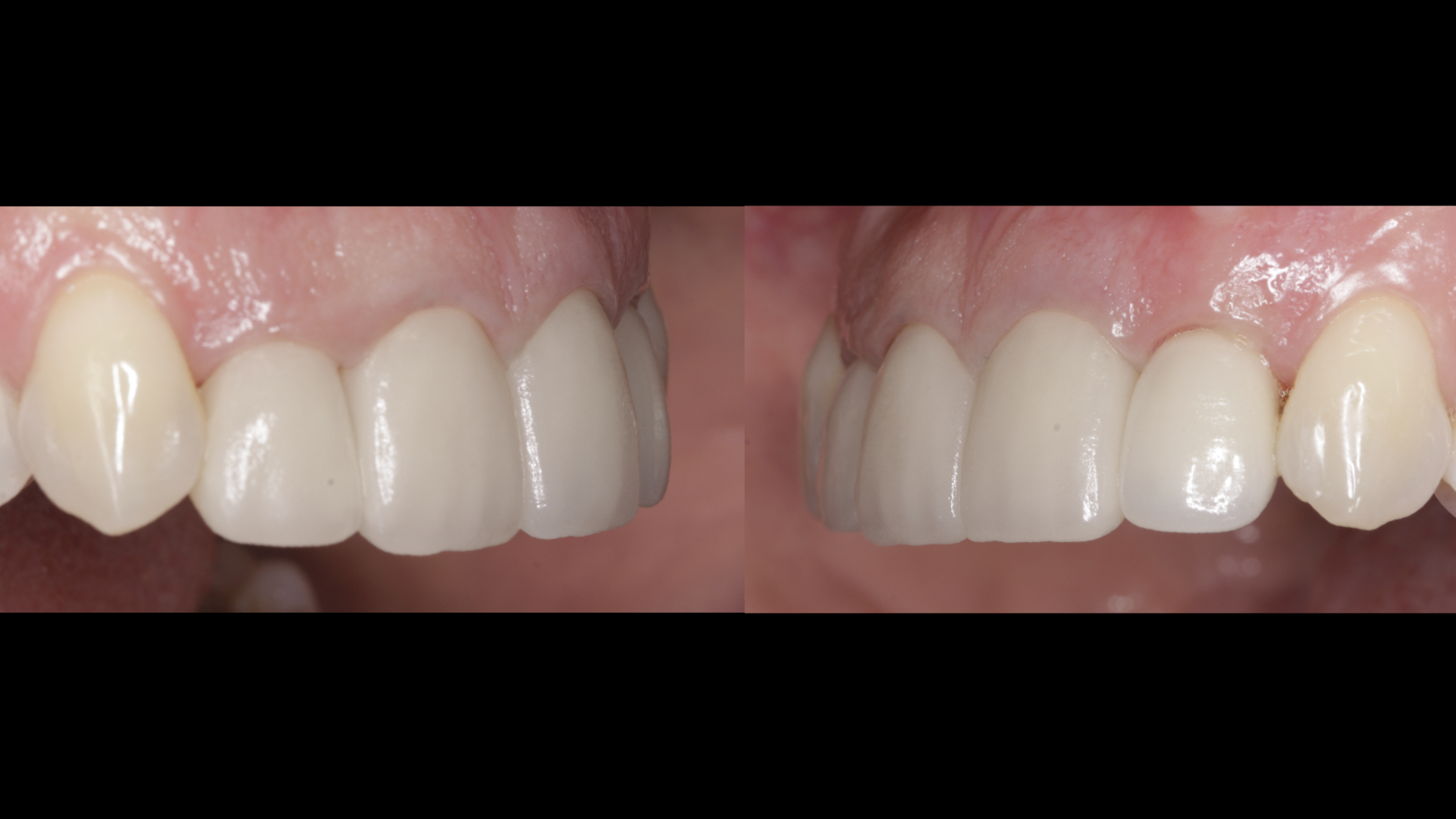 Vulkan Implants Clinical Case