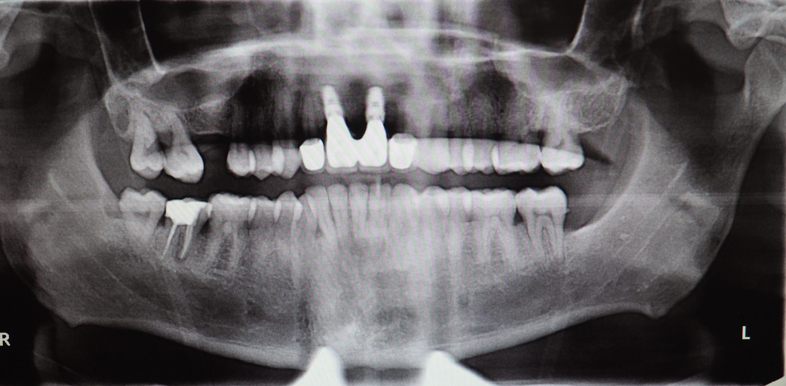 Sonrisa gingival y rehabilitación mediante implantes inmediatos en sector anterosuperior